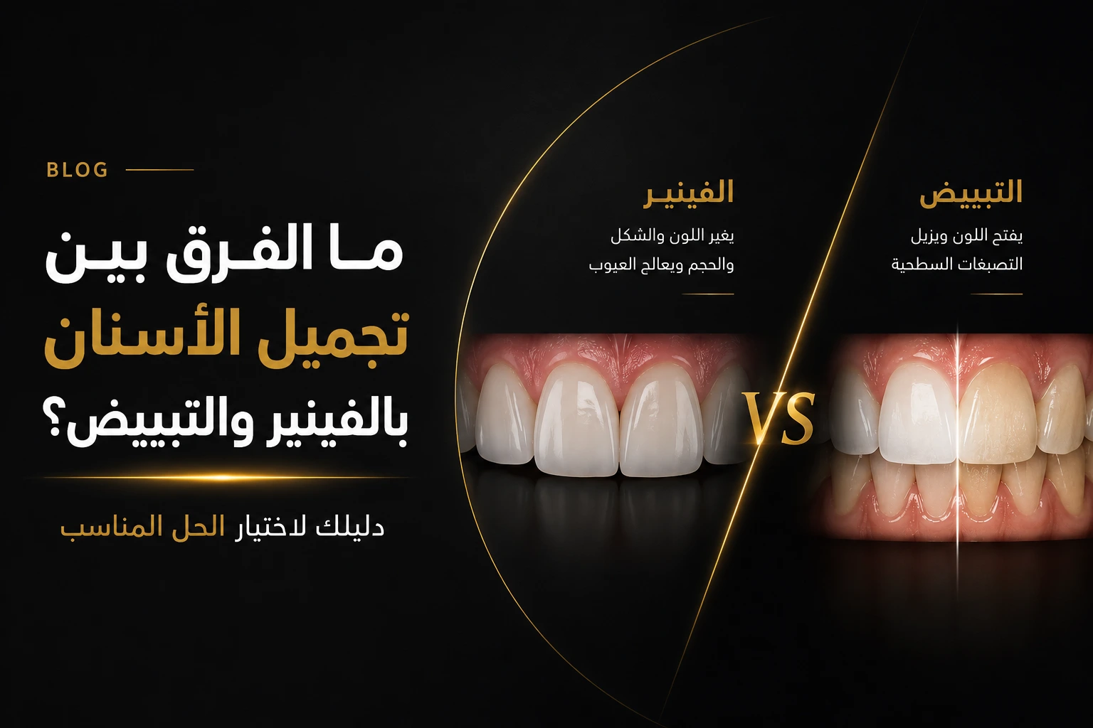 مقارنة بين الفينير وتبييض الأسنان توضح الفرق بين الإجراءين من حيث النتائج والاستخدام والحالات المناسبة.