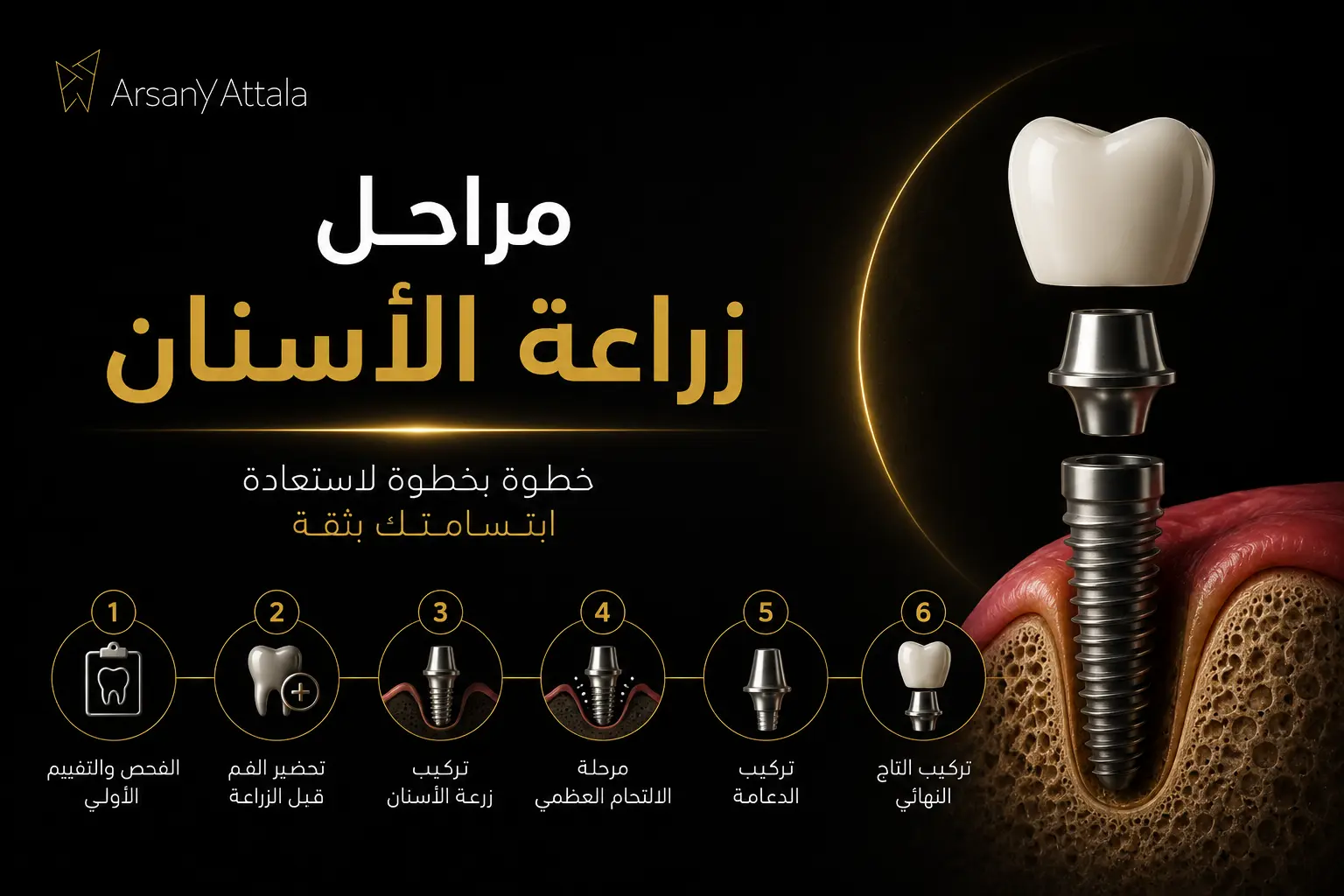مراحل زراعة الأسنان خطوة بخطوة مع د. أرساني عطالله